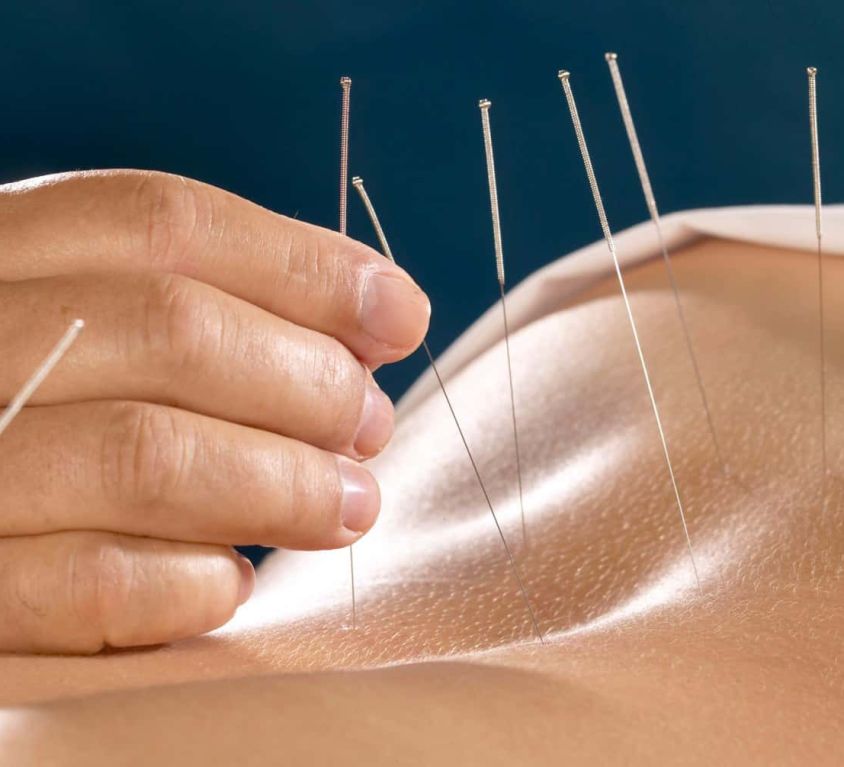 Anatomical Acupuncture